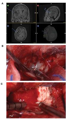 Tissues Harvested Using an Automated Surgical Approach Confirm Molecular Heterogeneity of Glioblastoma and Enhance Specimen's Translational Research Value